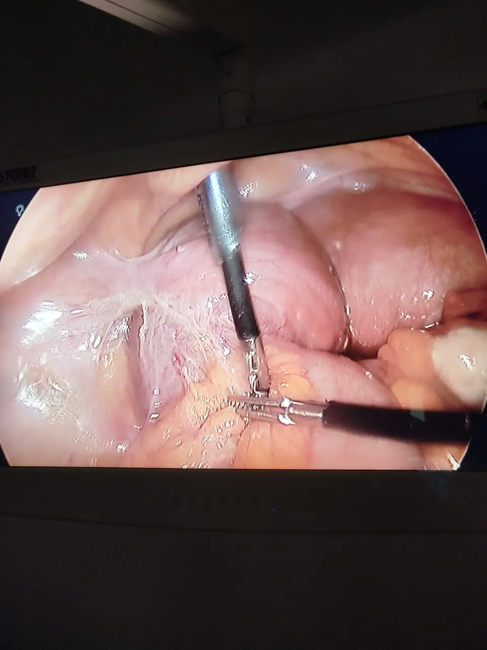 Vista laparoscópica de los órganos pélvicos en el monitor del quirófano durante una cirugía ginecológica en Star Médica Querétaro